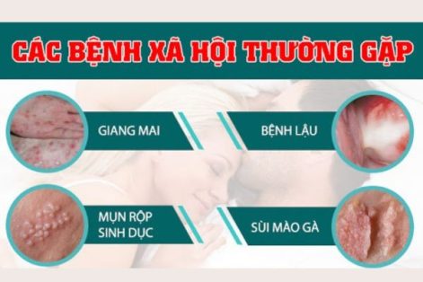 Những bệnh xã hội thường gặp ở nam và nữ hiện nay