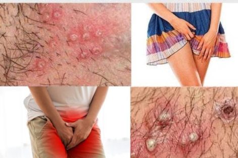 Nổi mụn có mủ trắng ở nam và nữ là do đâu?
