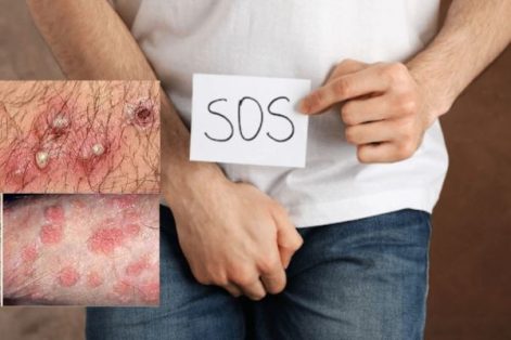 Nổi mụn mủ cậu nhỏ là bị gì?