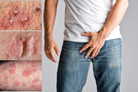 Cảnh giác với tình trạng nổi mụn mủ dương vật