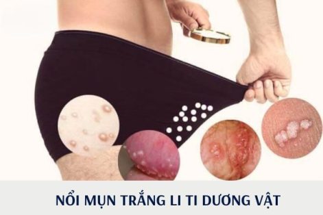 Nổi mụn trắng li ti dương vật là bị bệnh gì?