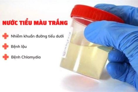 Cẩn thận khi gặp nước tiểu màu trắng bất thường