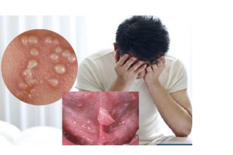 Sùi mào gà nam có chữa được không?
