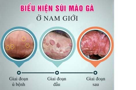 Dấu hiệu giúp nhận biết bệnh xã hội ở nam