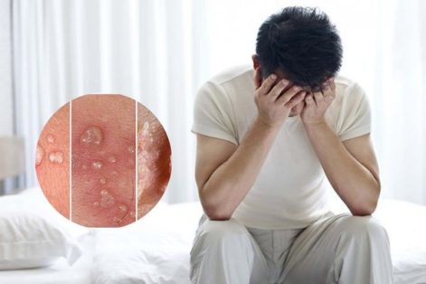 Bệnh sùi mào gà có tái phát lại không?