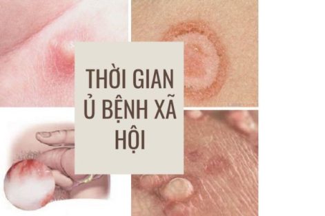 Góc giải đáp: Thời gian ủ bệnh xã hội bao lâu?
