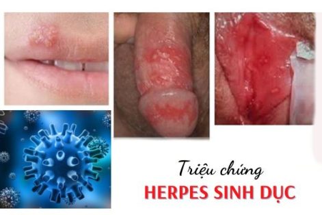 Nhận biết triệu chứng Herpes sinh dục