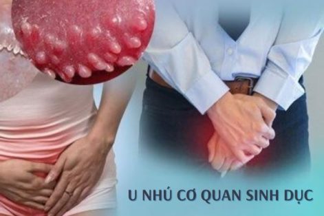 Tác hại nguy hiểm của u nhú cơ quan sinh dục cần lưu ý