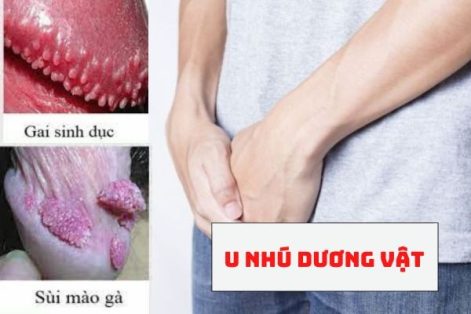 U nhú dương vật là do đâu?