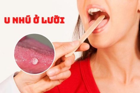 U như ở lưỡi – Dấu hiệu bệnh xã hội nguy hiểm