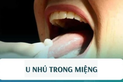 U nhú trong miệng là do đâu?