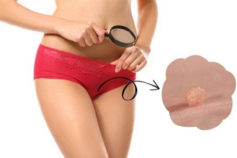 Cảnh giác khi bị u nhú vùng kín