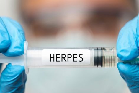 Các cách xét nghiệm Herpes sinh dục hiện nay