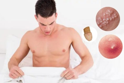 Chim bị nổi mụn trắng nguyên nhân và cách chữa trị