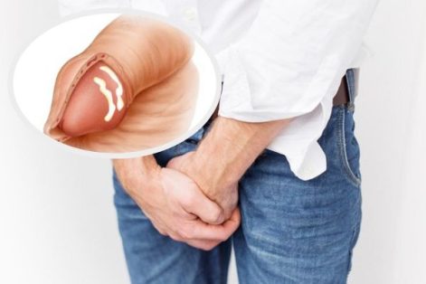 Đầu chim bé có mủ trắng là biểu hiện của bệnh gì?