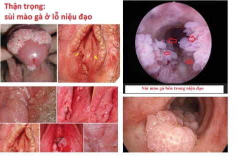 Sùi mào gà niệu đạo là bệnh gì nguy hiểm không?