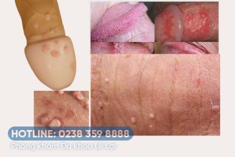 Dương vật nổi mụn trắng li ti: Nguyên nhân và cách chữa