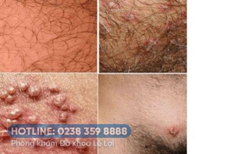 NỔI MỤN Ở VÙNG LÔNG MU LÀ BỆNH GÌ